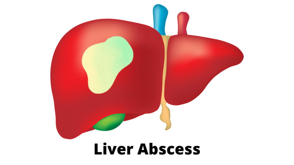 1-liver-abscess-symptoms-best-diet-tests-symptoms